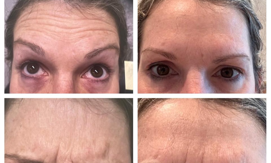 Image 6: Revanesse Versa Dermal Filler for Lips or Under Eyes
