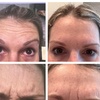 Image 6: Revanesse Versa Dermal Filler for Lips or Under Eyes