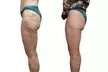 Up to 57% Off on Body-Tite – Non-Invasive Cellulite Reduction & Skin Tightening with Lymphatic Drainage in DC - Second Medium