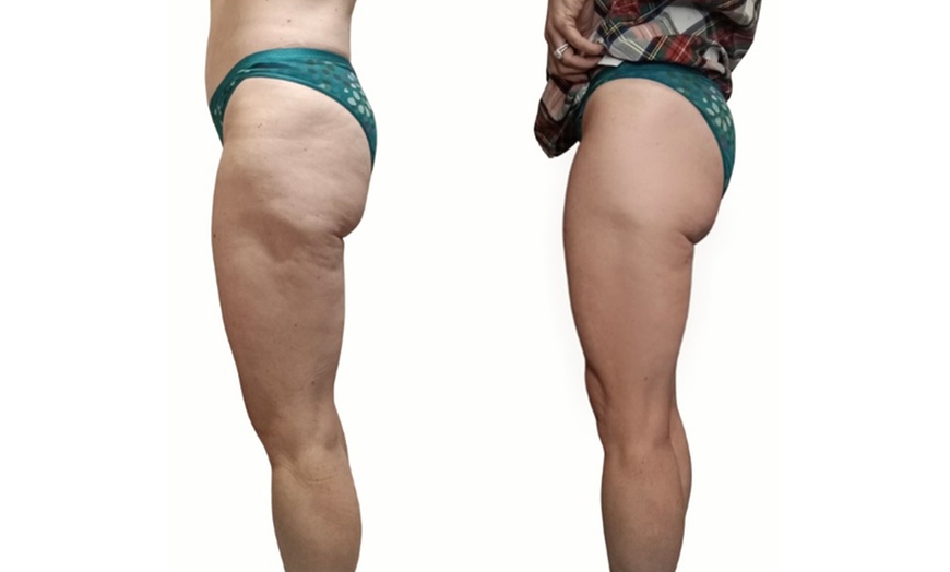 Image 1: Body-Tite – Non-Invasive Cellulite Reduction & Skin Tightening in DC
