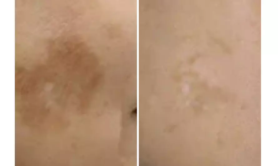 Spotless Skin: Remove 1, 3, or 5 Skin Tags, Age Spots & More 