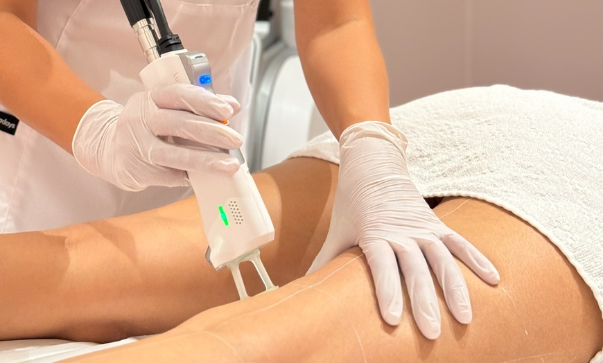 Image 1: 3 - 5 Laser-Haarentfernungen an einer kleinen Zone für 1 Person