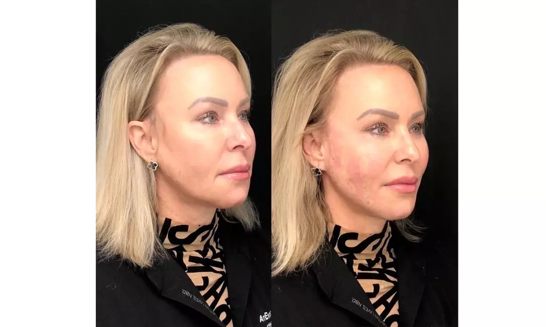 Experience Face PDO Thread Lift and Get a Rejuvenated Look!