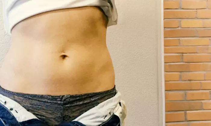 Kryotherapie an 1 Zone nach Wahl oder Bauch, Oberschenkeln und Armen (50% sparen) - Primary Image