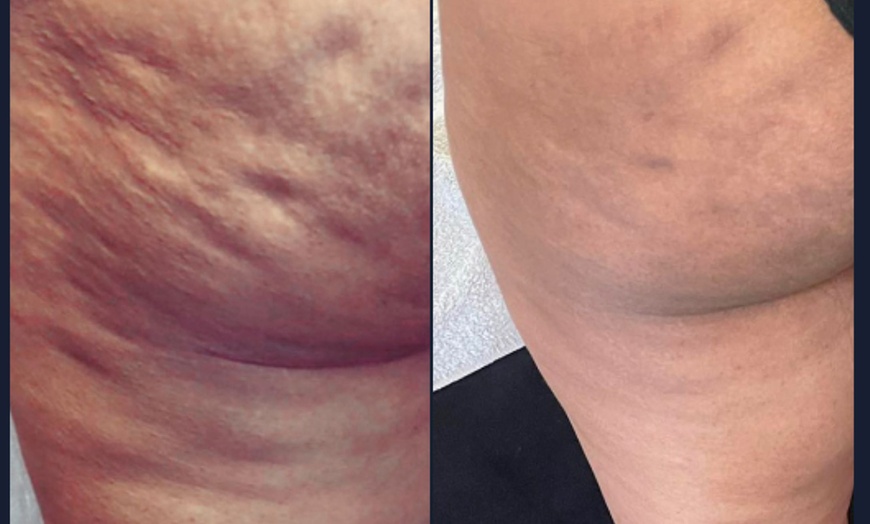 Image 4: Cryoslimming Body Sculpting – 1, 3, or 5 Session Packages