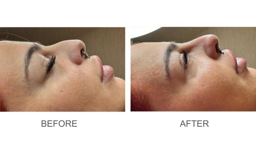 Image 4: Up to 56% Off on Dermal Filler at eLavish Aesthetics