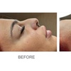 Image 4: Up to 56% Off on Dermal Filler at eLavish Aesthetics