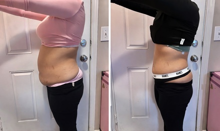 Two Sexy & Tight Radio-Frequency Skin-Tightening Laser Lipo Treatment (40 min) - Pretty Lyfe Esthetics