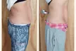Up to 78% Off on Cryotherapy - Cryosurgery at Skin Memoirs by Arianna Nesbeth - Second Medium