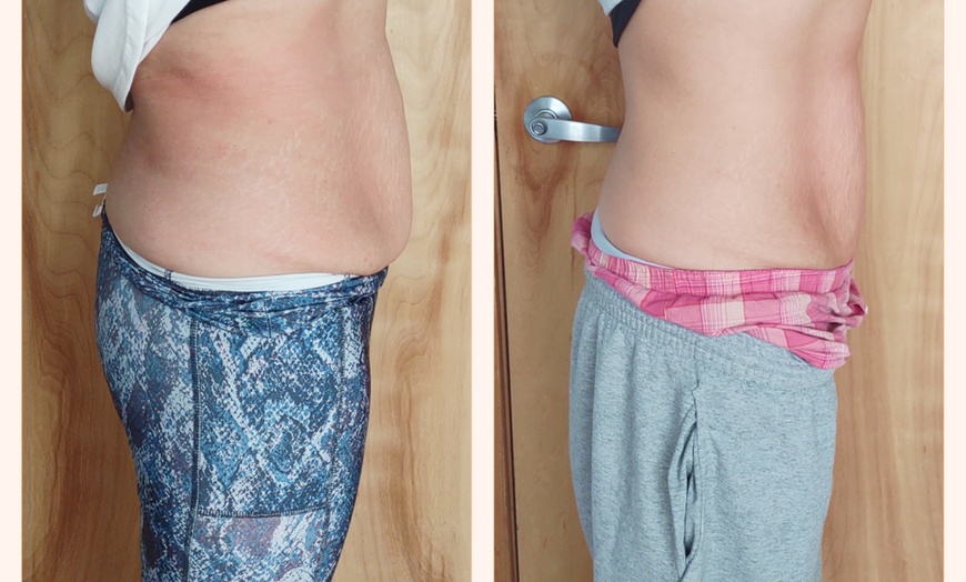 Image 2: Up to 78% Off on Cryotherapy - Cryosurgery at Skin Memoirs by Arianna Nesbeth