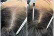 Achieve Thicker Hair with 30-Minute One, Two, or Three Alma TED Hair Restoration Sessions (Up to 50% Off) - Second Medium