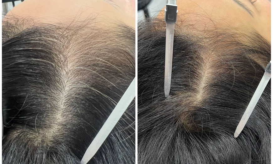 Image 4: 30-Minute One, Two, or Three Alma TED Hair Restoration Sessions