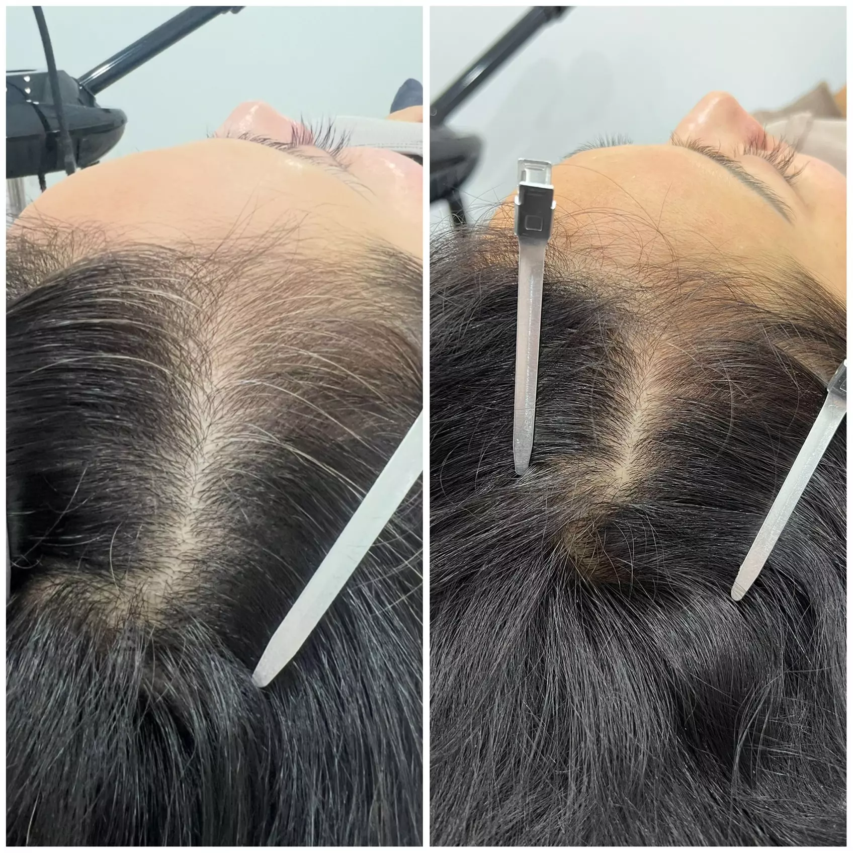 30-Minute One, Two, or Three Alma TED Hair Restoration Sessions