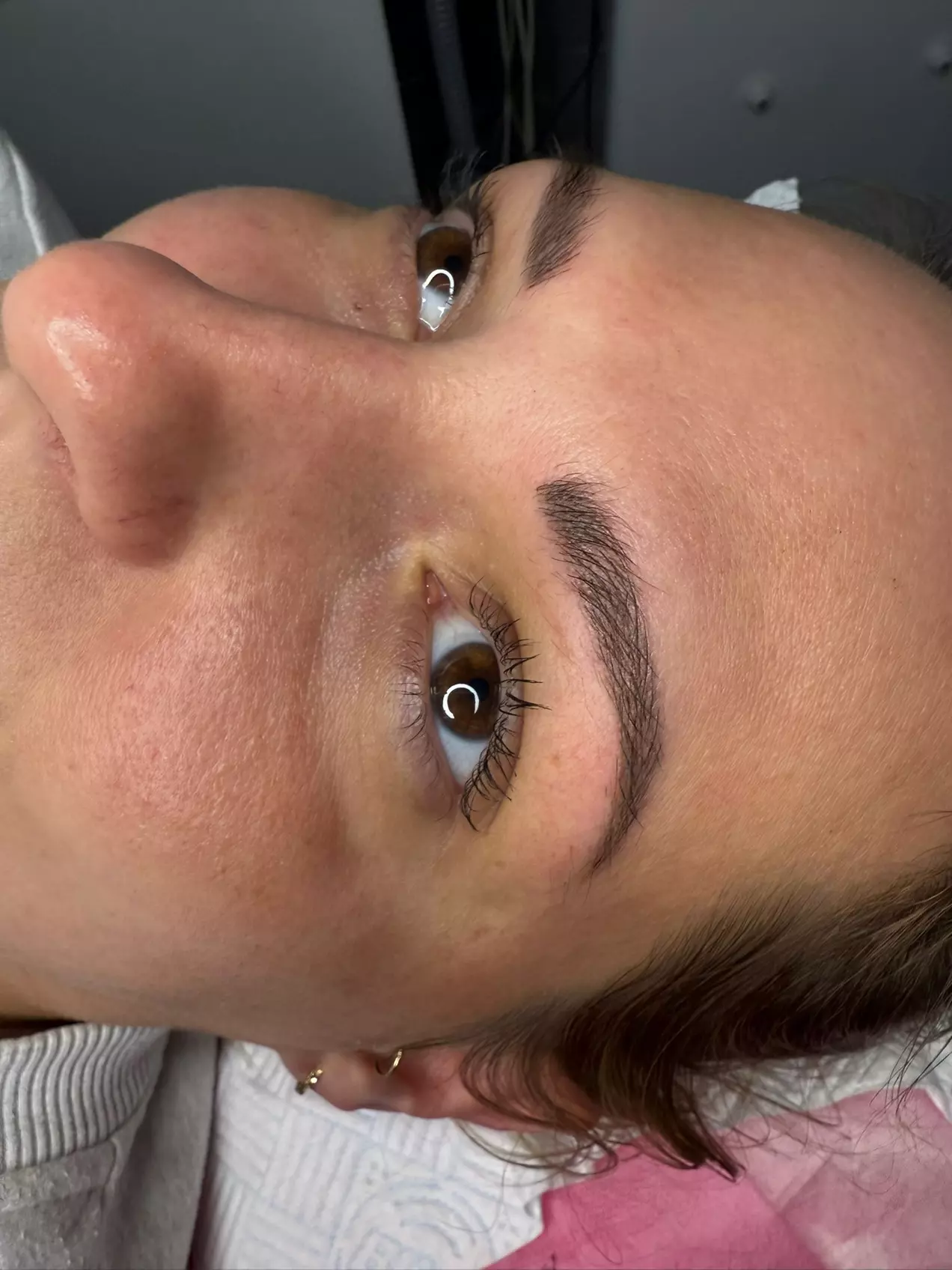 Up to 58% Off on Injection - Dermal Filler at Ana Medical