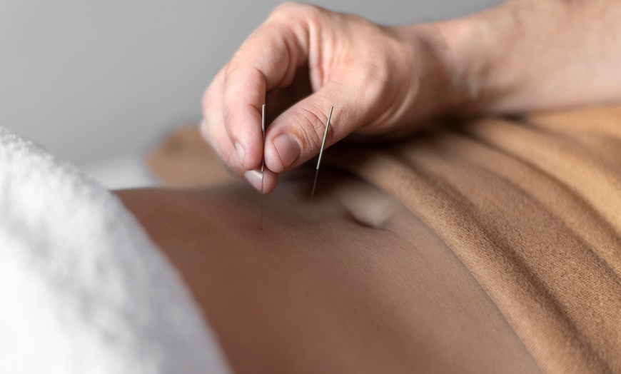 Image 5: 1 o 3 sesiones de acupuntura con opción a masaje tuina para 1 persona