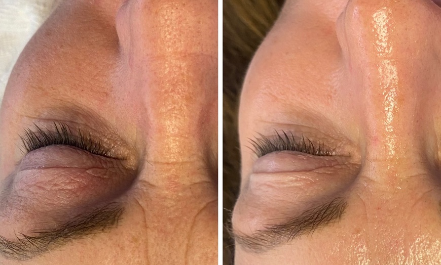 Image 5: Microneedling-Behandlung oder Enzym-Lifting-Paket für 1 Person