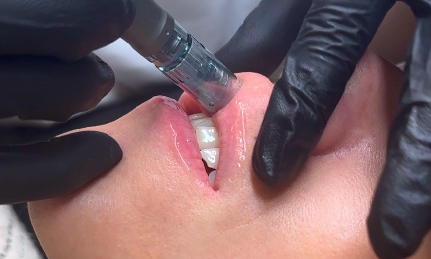 Image 1: Sesión de rehidratación de labios con dermapen y vitaminas para 1 