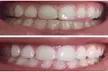 Professional 3D Teeth Whitening Kit with Remineralization Gel - 1 or 2 pack | Dental-Quality Results & 5-Day Shipping - Second Medium