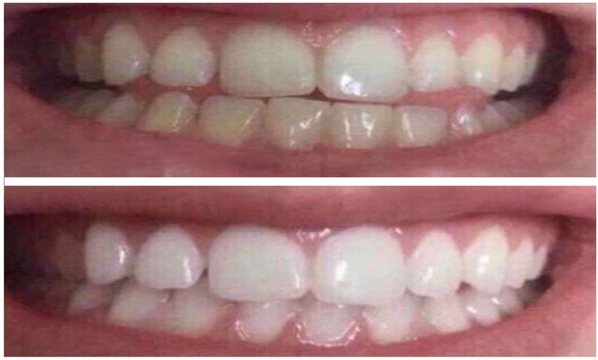 Image 3: Professional 3D Teeth Whitening Kit w Remineralization Gel: 1 & 2 pack