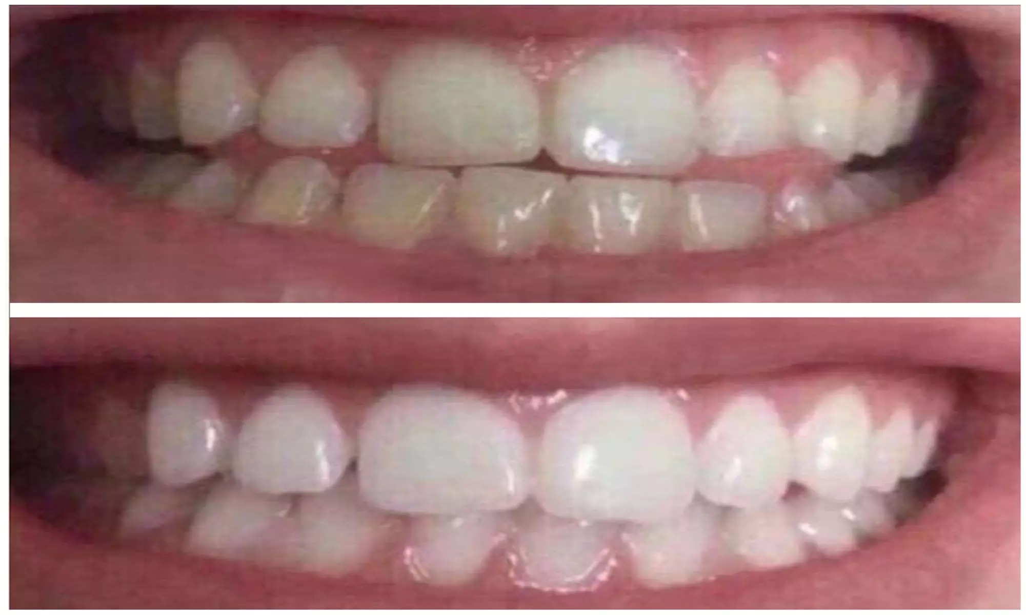 Professional 3D Teeth Whitening Kit w Remineralization Gel: 1 & 2 pack