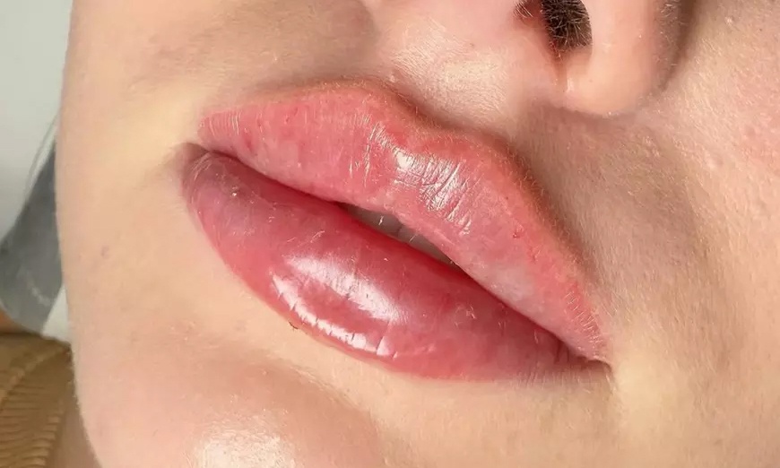 Image 2: Enhance Your Beauty with 1ml or 2ml Dermal Filler