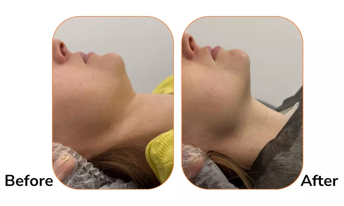 SMAS lifting HiFu na wybrane obszary