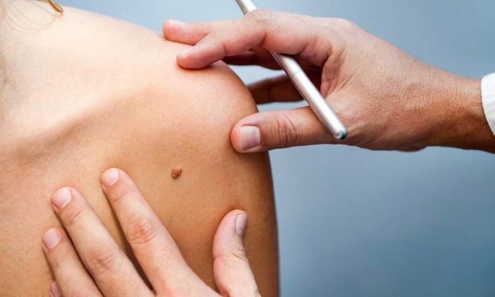 Mole and Growth Removal Using New Vaporizing Technology