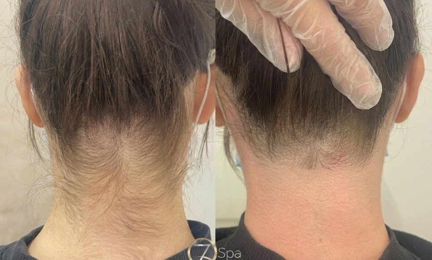 Image 5: Three Laser Hair Removal for Small or Medium Areas for Smooth Skin