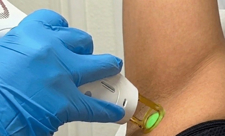 Image 2: Laser Hair Removal Multi-Session Packages