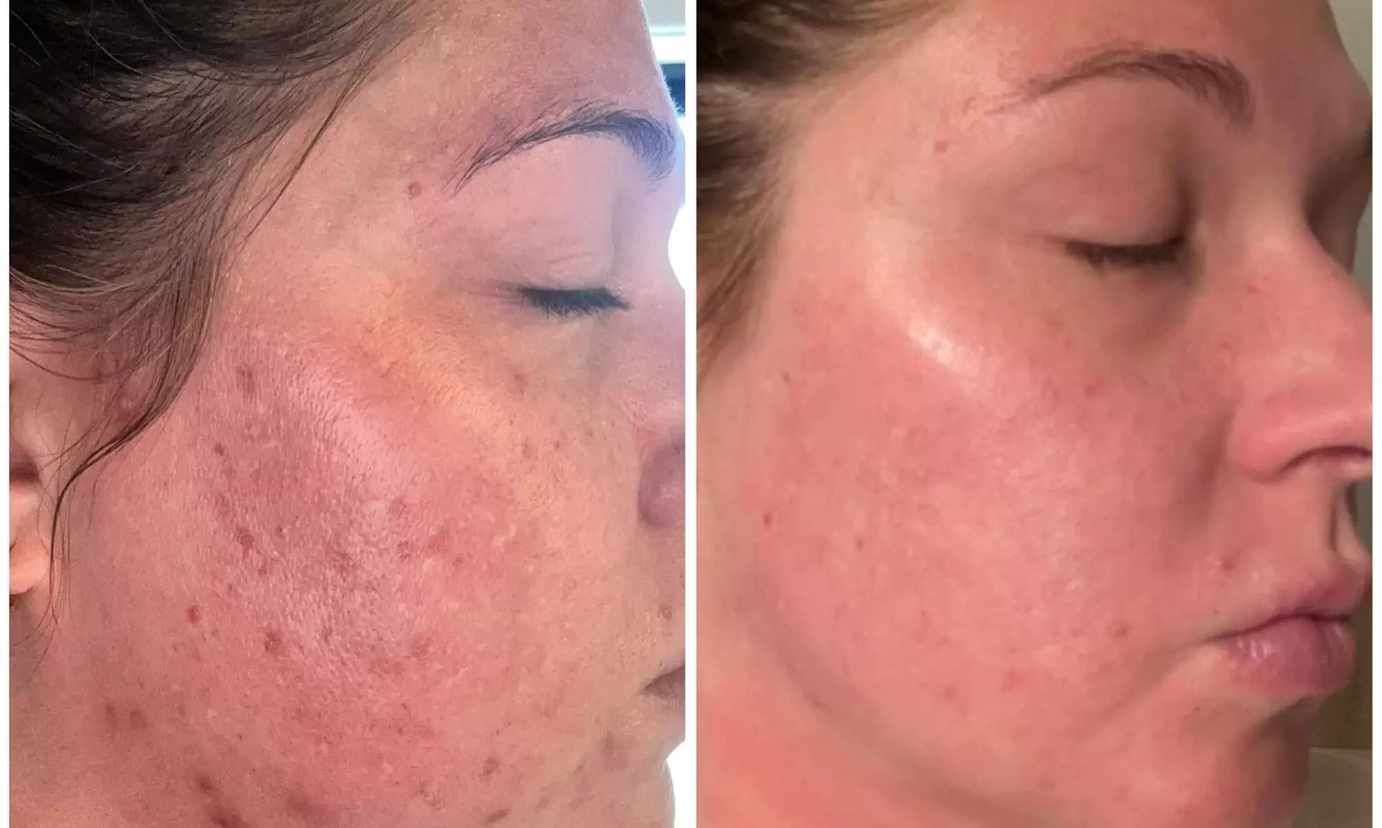 Permanent Makeup & Advanced Microchanneling