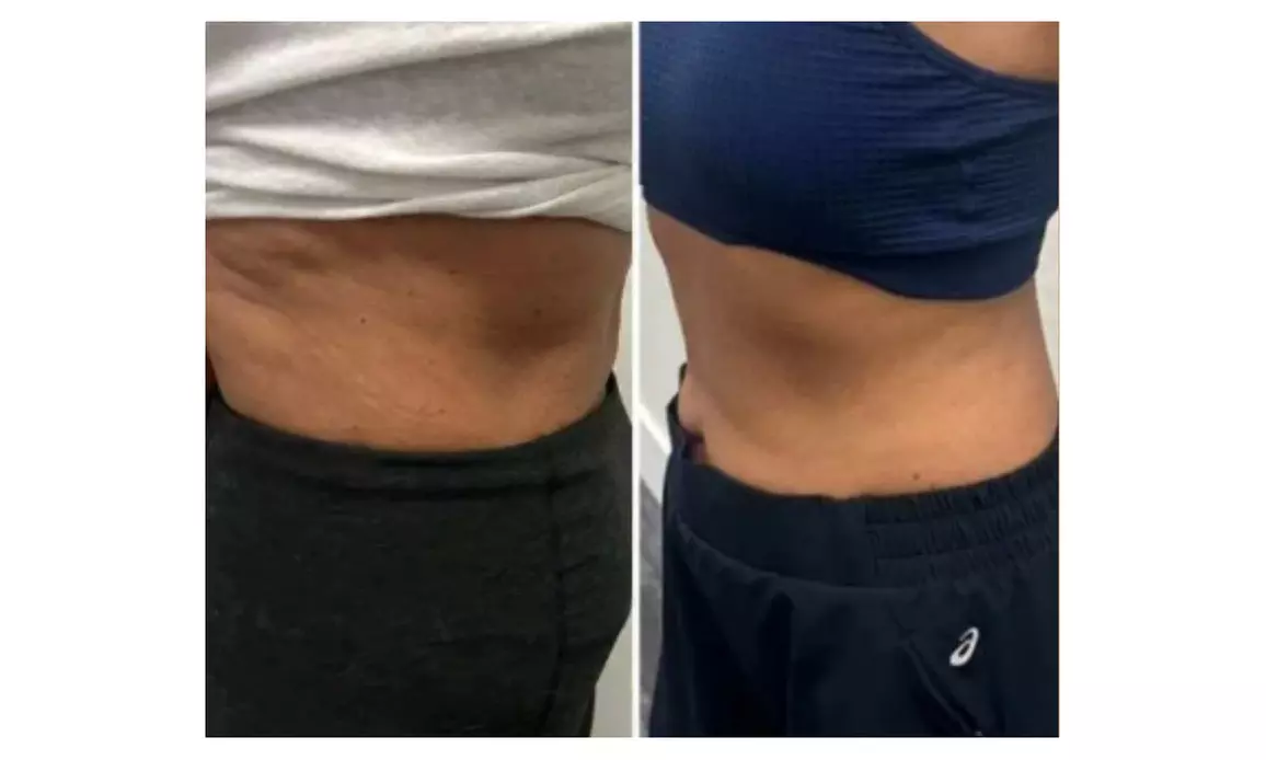 One or Two High Intensity Focused Electromagnetic Treatment + RF