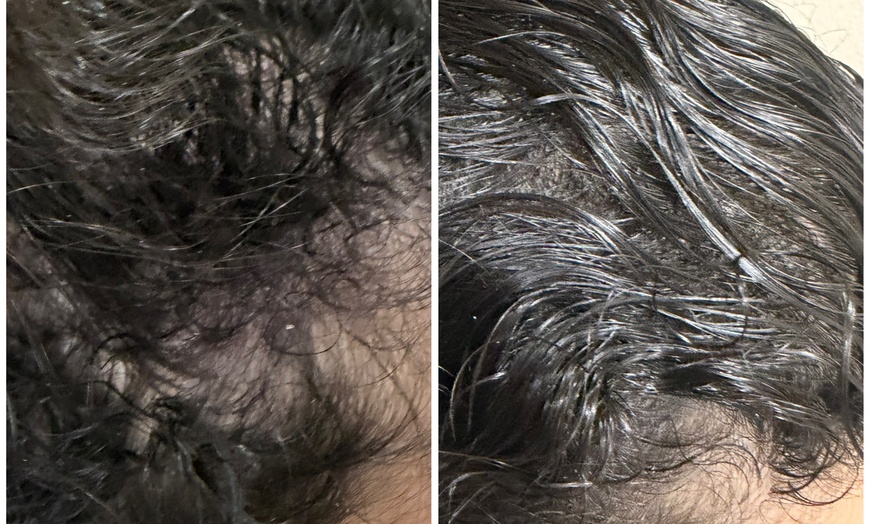 Image 2: Dermclar Method Hair Loss prevention and Neck Massage