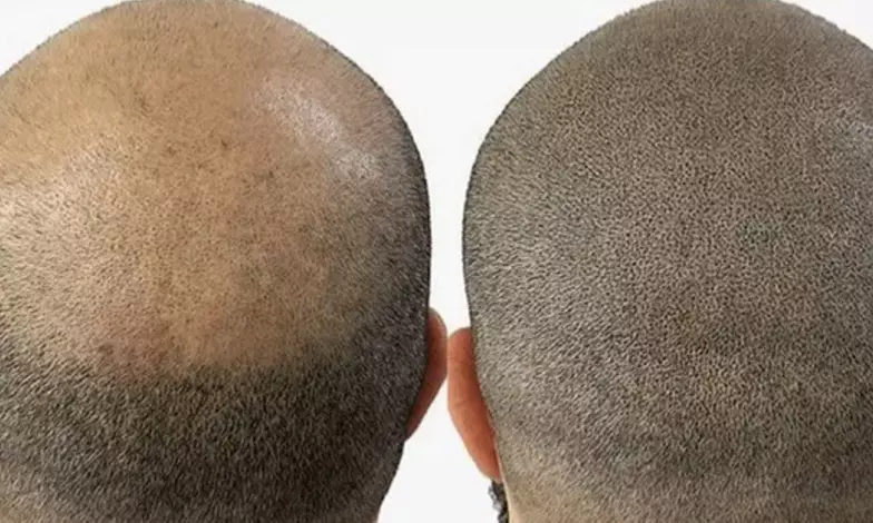 Scalp Micropigmentation Hair Loss, Balding, or Thinning Treatment