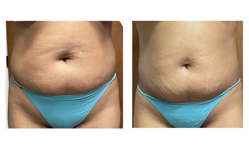 Image 2: 30 or 60-Min Brazilian Lymphatic, Body Wrap, Wood Therapy, & More