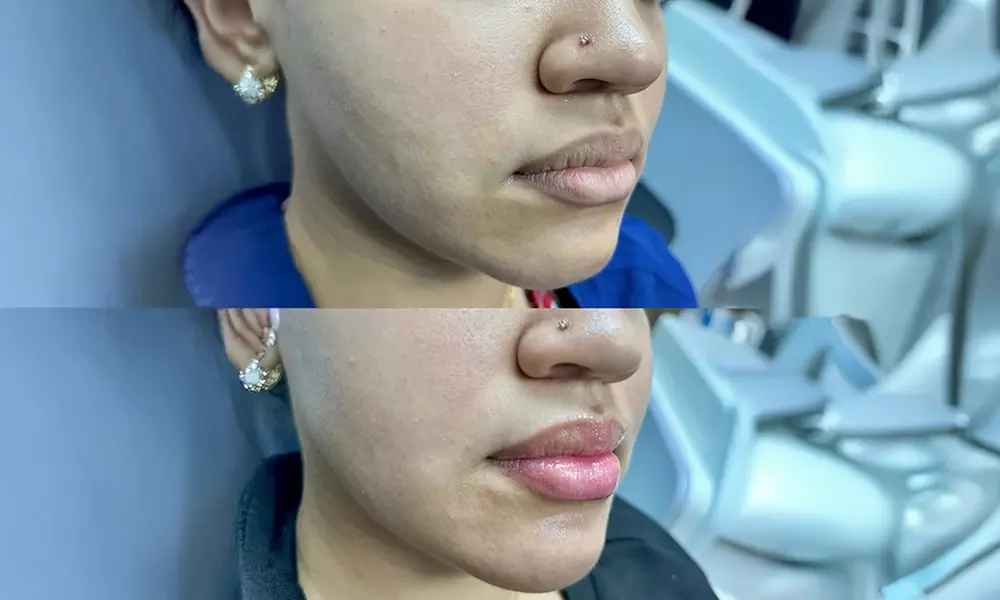 6 Laser Hair Removal Sessions for Any Area Size – Silky Skin Awaits