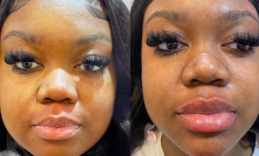 Image 2: Rejuvenate Your Look with 20 or 40 Units of Juveau