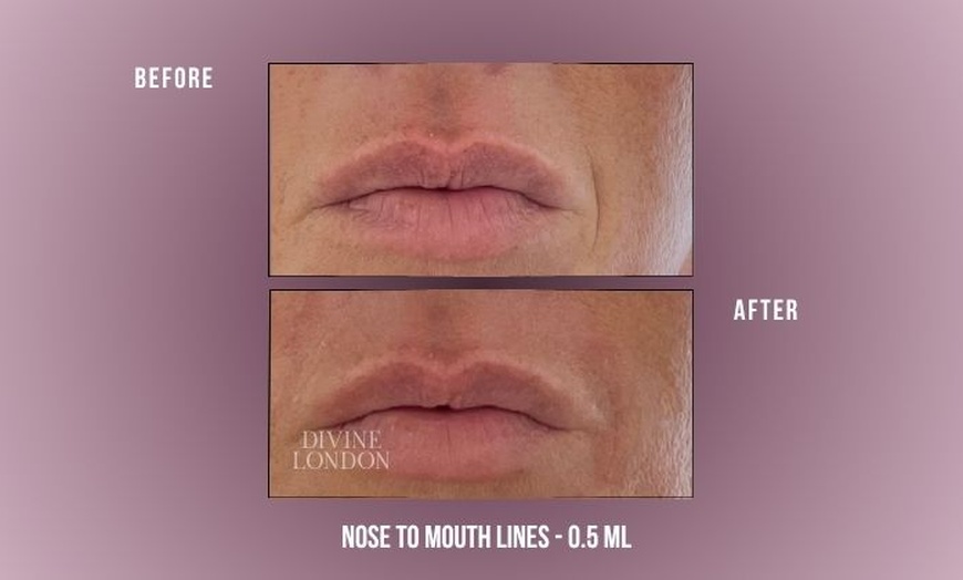 Image 6: Up to 71% Off on Injection - Dermal Filler at Divine Aesthetics Clinic London