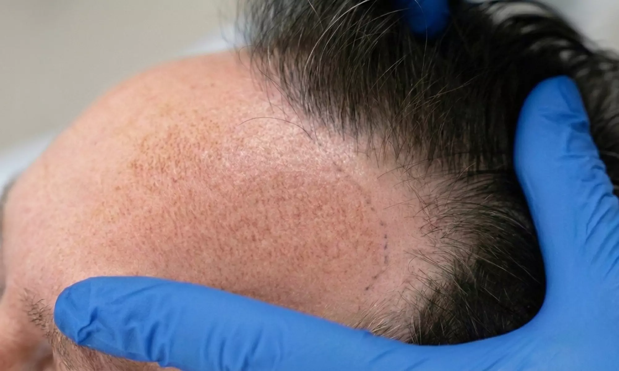 PRP/PRF Hair Restoration: Options for Hairline, Half Scalp, or Full Head at Better Off Med Spa (Up to 50% Off) - Primary Image