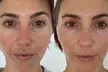 Rejuvenate Your Skin with One, Three, or Five Micro Needling Treatments at Skin by SJ (Up To  70% Off) - Second Medium
