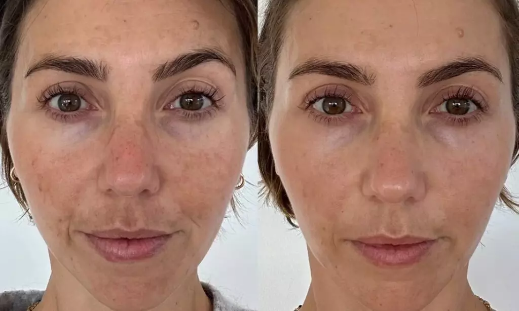 Get Smoother Skin with One, Three, or Five Micro Needling Treatments