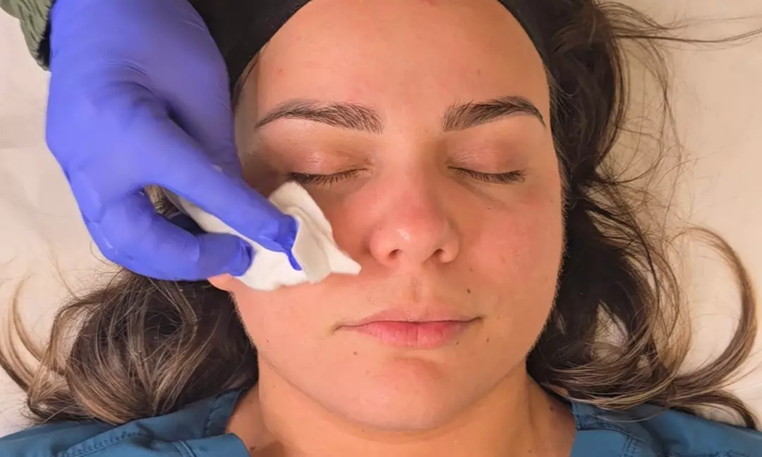 Experience Radiance: One or Three Light or Deep Chemical Peels