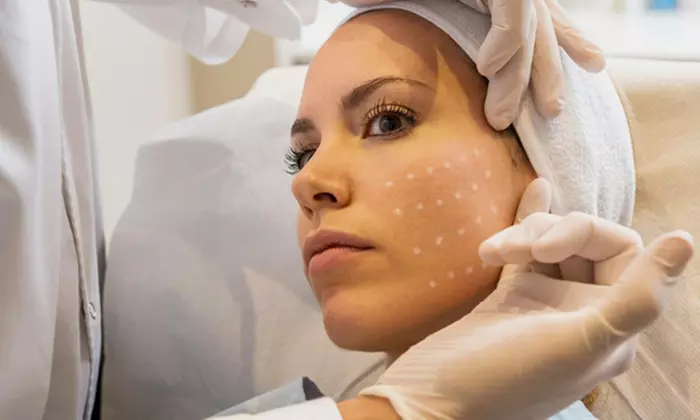 1 o 3 sesiones de mesoterapia facial con cóctel de vitaminas