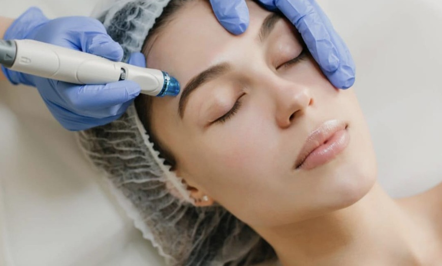 Image 6: Limpieza facial con punta de diamante, 1 o 3 sesiones