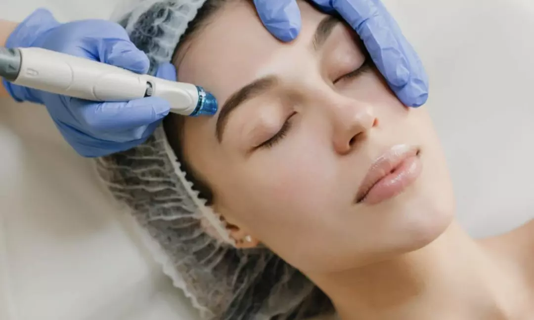 Limpieza facial con punta de diamante, 1 o 3 sesiones