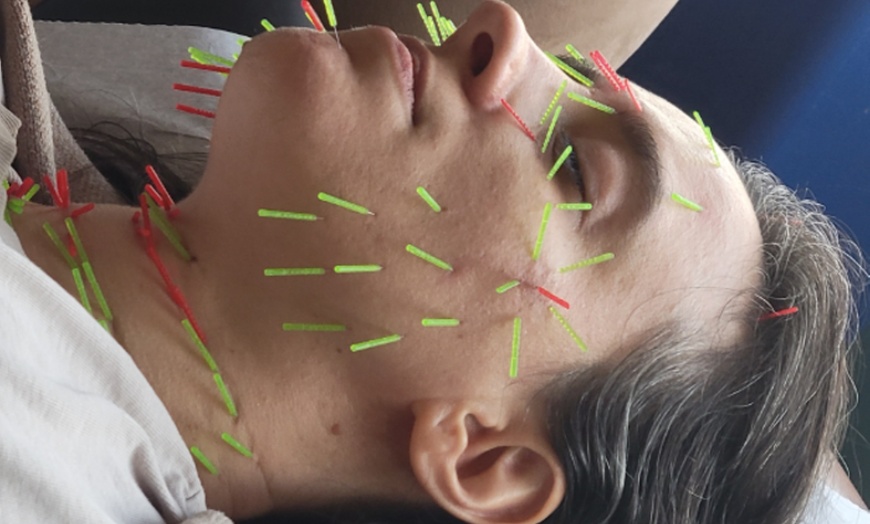 Image 3: Boost Wellness with One or Two Acupuncture & Cupping Treatments