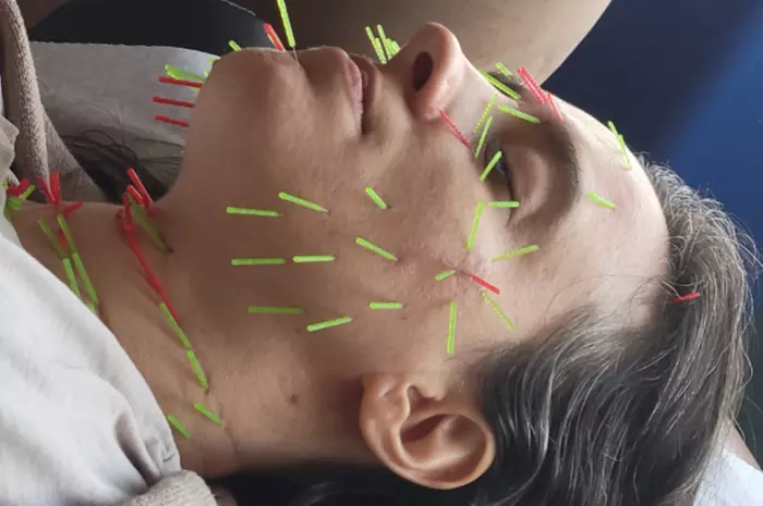 Boost Wellness with One or Two Acupuncture & Cupping Treatments