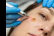 Vitality’s Skin Renewal – Remove Skin Tags, Brown Spots & Spider Veins (Up to 6 Areas, Save Big!) - Second Medium