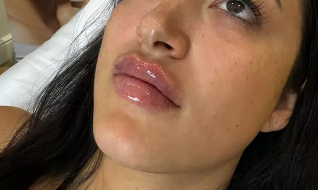 EPTQ Lip Filler 0.5ml or 1.1ml for Fuller, Defined Lips