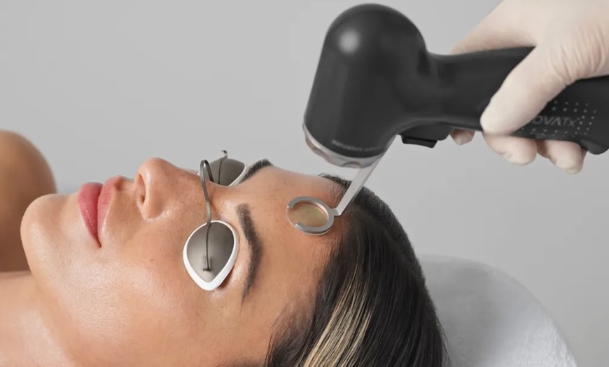 Image 2: Transform Your Skin with 1 or 3 Rosacea Treatment Sessions At Drops of Beauty Anti-Aging Med Spa (Up to 56% Off)