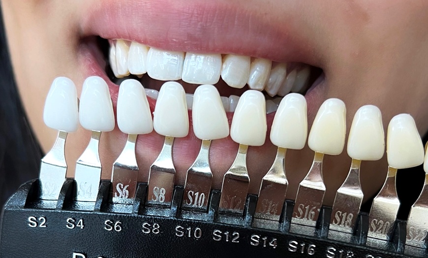 Image 1: Séance de blanchiment dentaire avec Sowfel